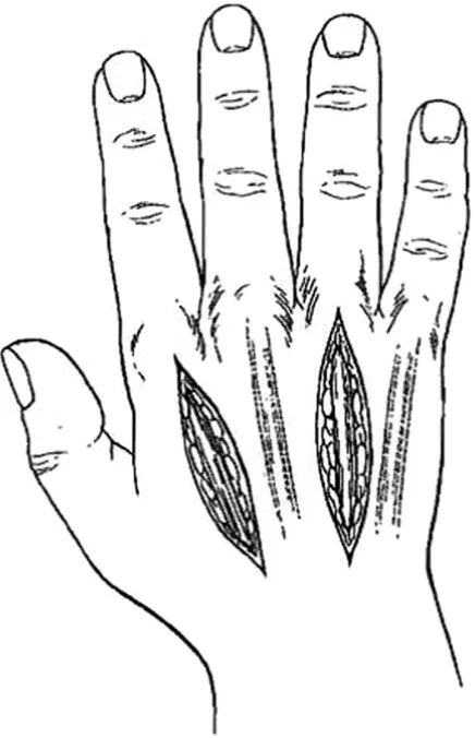 Figure 5 illustration demonstrating two longitudinal incisions made over the 2nd and 4th metacarpals to release the dorsal and volar interosseous compartments and the adductor compartment of the thumb