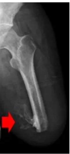 Figure 1 Radiographic image demonstrating heterotopic ossification within the residual limb of a combat-injured service member.