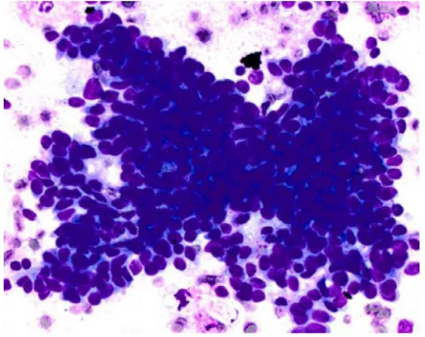 Figure 4 Bronchial epithelial cells with radiation atypia.Notes: The cells show a spectrum of changes ranging from obviously recognizable benign to highly atypical morphology