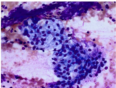 Figure 7 Granuloma associated with squamous cell carcinoma.Note: A small aggregate of epithelioid histiocytes (arrow) is present in a background of tumor cells and necrotic debris.