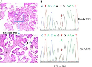 Figure 1 Co-amplification at lower denaturation temperature polymerase chain reaction (COLD-PCR) increases ability to detect BRAF mutations in ovarian serous borderline tumors (SBTs).Notes: (A) Hematoxylin and eosin staining of a representative SBT showing