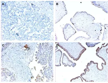 Table 5 BRAF mutation frequency in mucinous borderline tumors (mBT) and mucinous carcinomas (MOC)