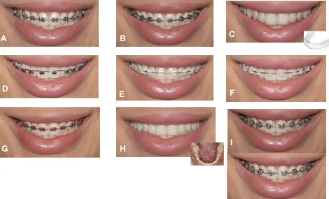 Figure 1 The different orthodontic appliances displayed in the questionnaire.
