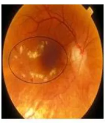 Fig 13.  Exudate 