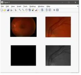Fig 19 . Results showing that the test fundus is not a     haemorhage and it has DR. 