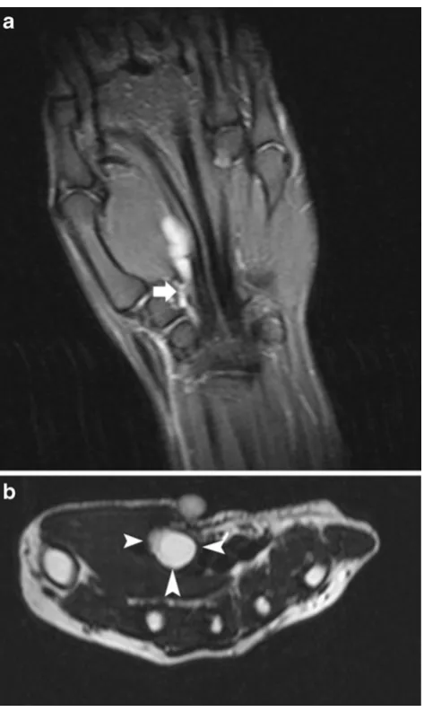 Fig. 3 Volar ganglion cyst. a Coronal FS T2-WI. Note a polylobularhyperintense cystic structure with a small stalk-like connection to theadjacent scaphotrapezial joint (arrow)