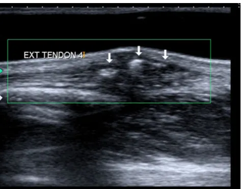 Fig. 10 De Quervain tenosynovitis. a Plain radiograph showing anon-specific soft tissue swelling at the radial styloid process (arrow)