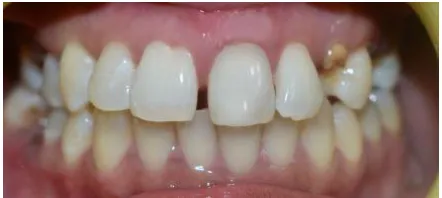 Fig 4  inside/outside power bleaching                                                 Fig 5- Post operative clinical photograph 