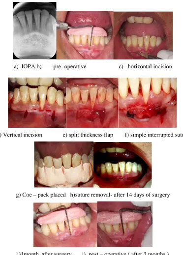 Fig 1 -  a)  IOPA ,  b) pre- operative, c)   horizontal incision  d) Vertical incision e) split thickness flap ,f) simple interrupted 