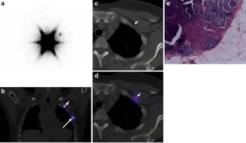Fig. 5a–e SPECT/CT case acquired on Symbia T2 (Siemens Health-care). A 54-year-old woman with breast carcinoma (pT1) for SLNmapping