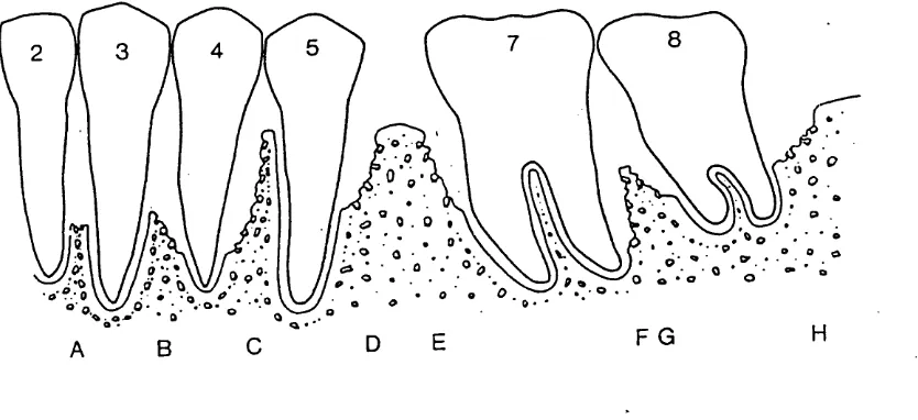 Figure 7. Two-dimentional image of interdental bone defects (Jenkins et al. 1988)