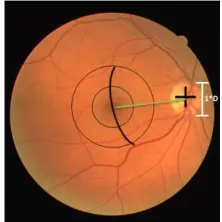 Fig. 11:  Macula region detection from center of optic disc  