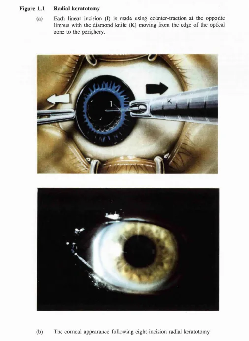 Figure 1.1 Radial keratotomy