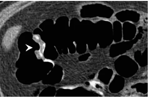 Fig. 3 a Three-dimensional view of the rectum showing a smallpolypoid defect surrounded by some fluid (white arrowhead)