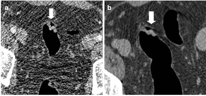 Fig. 5 a Three-dimensionalview of the splenic flexurereveals multiple polypoiddefects