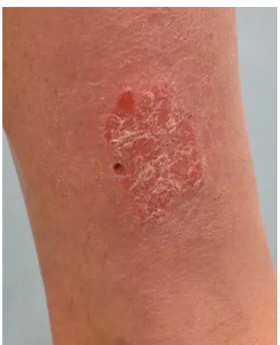 Figure 1 Plaque type psoriasis on lower extremity prior to treatment with excimer laser.