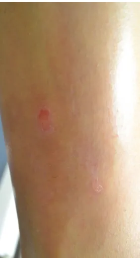 Figure 2 Plaque type psoriasis on lower extremity after eight treatments with excimer laser according to MED protocol.Abbreviation: MED, minimal erythema dose.