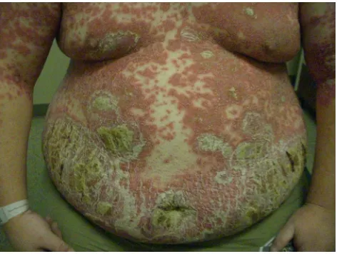 Figure 1 Generalized pustular psoriasis.Notes: Innumerable pustules studded on a background of erythematous plaques on the chest, abdomen, and upper arms