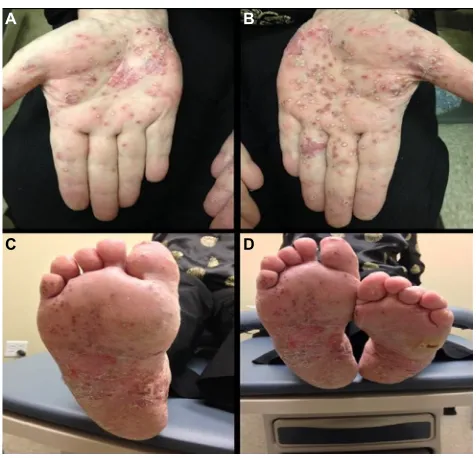 Table 3 Treatment of infantile and juvenile pustular psoriasis