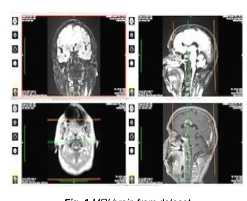 Fig. 1 .MRI brain from dataset 