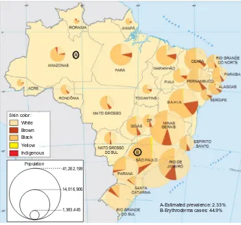 Figure 1 Brazilian Federal Units and their respective skin color distributions and populations.Notes: (A) estimated prevalence of psoriasis in an Amazonian state (Northern Brazil);37 (B) Psoriasis is the most frequent cause of erythroderma (44.9%) in São P