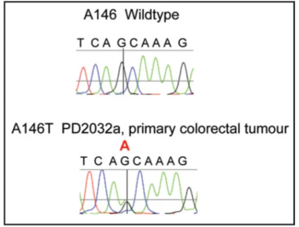 Figure 1.Representative sequencing chromatogram of c.436G>A p.A146T KRAS mutation from
