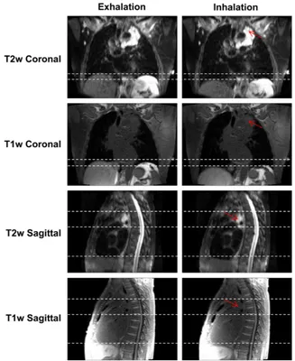 FIGURE 9. Snapshots of 4D-T1w and 4D-T2w MRI at the exhalation and inhalation respiratory phases for patient 3, who was diagnosed with T4N2adenocarcinoma