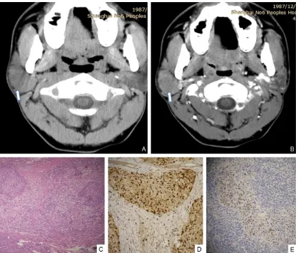 Figure 1. LEC of right parotid gland in a 24-year-old woman. A: An irregular nodule of soft-tissue density was seen in the right parotid gland on plain CT, poorly defined margins