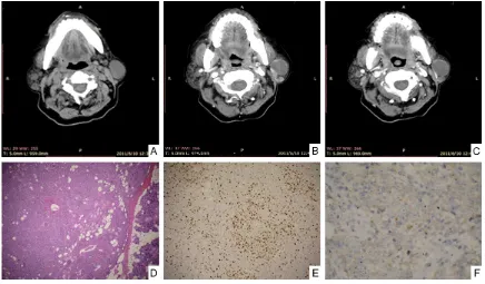 Figure 4. Multiple LECs in bilateral parotid glands associated with BLEL in a 55-year-old woman