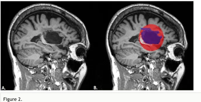 Figure 2. We tested our toolbox on a mock lesion mask. A. The stroke subject's T1 anatomical scan; B.The mock lesion mask is the red sphere; the blue mask is the lesion segmentation