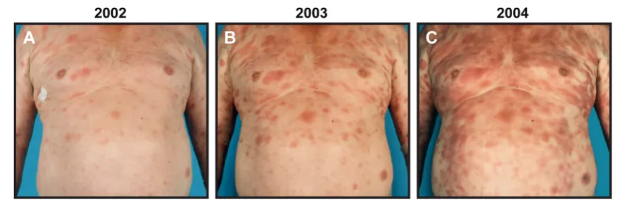 Fig. 1 Progressive MF.that during a 3-year period (2002 a–c Example of a patient with progressive MF–2004) presents with increasing skininvolvement and inflammation