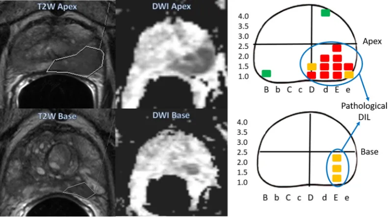 Fig. 1. Schematic representation of (A) imaging and pathological trafﬁc light classiﬁcation and (B) delineate-modiﬁed Barzell zones (see Supplemental Appendix B).