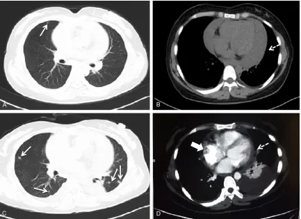 Figure 2. Images of the abdominal enhanced computed tomography. A and B: Scattered low-density nodules in the liver, indicating metastatic tumors (arrows).