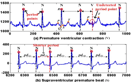 Fig. 1.Two examples of local anomaly in ECG time series