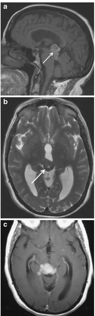 Fig. 13 Pineal melanoma in a 65-year-old woman with diplopia andworsening hearing loss