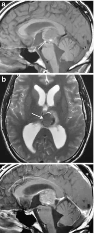 Fig. 14 Primitive neuroectodermal tumour (PNET) involving the pi-neal gland in a 3-year-old boy