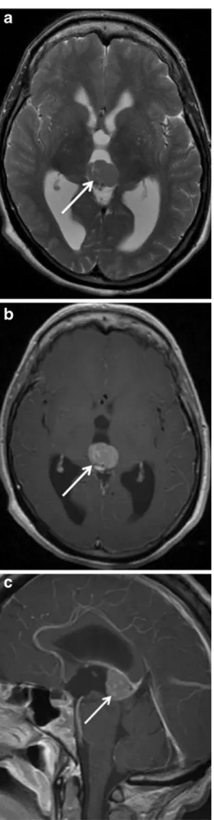 Fig. 3 Pineal parenchymal tumour of indeterminate differentiation(PPTID) in a 33-year-old woman with blurry vision and headaches.A circumscribed lesion with well- defined margins is seen involvingthe pineal gland (arrow), which has mixed intermediate and h