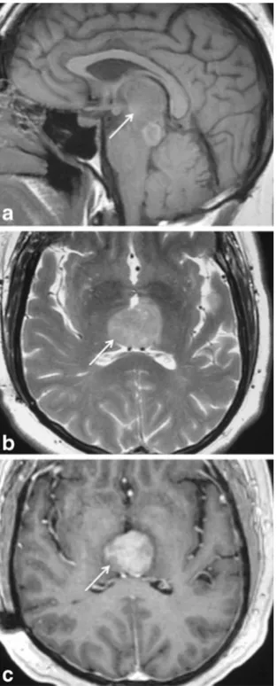 Fig. 4 Papillary tumour of the pineal region (PTPR) in a 6-year-oldquadrigeminal plate