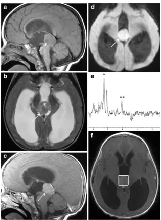 Fig. 5 Pineoblastoma in a 18-acquisition with point resolvedspectroscopy (PRESS)demonstrates elevated cholinepeak (*) and decreased NAA(**) (weighted image shows locationof the voxel surrounding thetumour (month-old boy