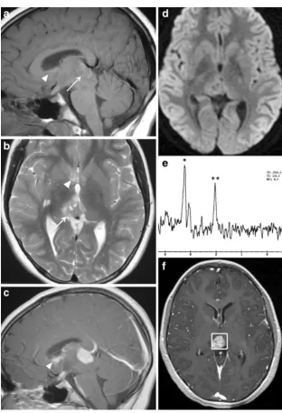 Fig. 6 Germinoma in a 12-intermediate to high signal onsagittal T1-weighted image (and axial T2-weighted image(enhancement on sagittalT1-weighted image (lateral and third ventricles withprominent enhancement