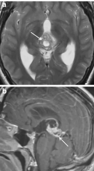 Fig. 9 Pineal embryonal carcinoma. The tumour involving the pinealgland (arrow) has lobulated margins with intermediate to high signalon axial T2-weighted image (a)