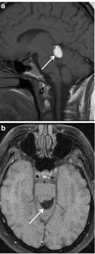Fig. 11 Pineal lipoma. Sagittal T1-weighted image (a) shows a well-circumscribed high signal lesion (arrow) involving the dorsal portionof the tectal plate extending into the pineal recess