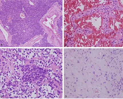 Figure 2. Pathological examination revealed the nested growth of cells of a gastric glomus tumor