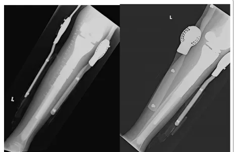 Figure 6 Postoperative radiographs showing the implantwithin the bone with an external knee brace.