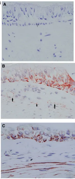 Figure 1 (i) Expression of uPAR in bronchial biopsies. (A) healthycontrol, (B) asthma subject revealing staining in the epithelium andcells within the lamina propria (highlighted by arrows) and (C)asthma subject revealing staining in the epithelium and air