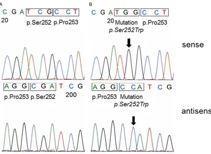 Figure 1. A. Representative example of FGFR2 codon p.Ser252 and p.Pro253 sequence analysis of a DNA from a bladder tumor