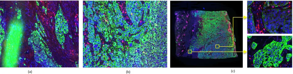 Figure 1. The detection of CK+ tumor epithelium regions in IF images (R:CD8, G:CK and B:Hoechst) is challenged bythe presence of artefacts (a) by the unspeciﬁc staining of other tissue types, such as necrotic tissue (b), as well as by thevariability of the