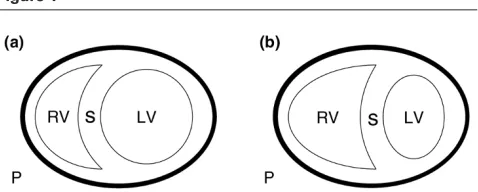 Figure 1pulmonale. The two main causes are massive PE and ARDS[7-9]. More importantly, when the underlying cause of acute