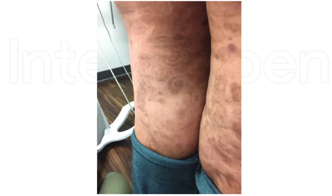 Figure 5. Epidermolysis bullosa acquisita patient with post inflammatory hyperpigmentation in annular pattern on legs.