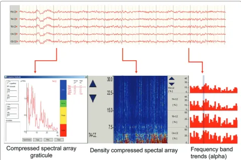 Figure 4. Transformation of raw electroencephalogram (EEG) into quantitative EEG (qEEG)